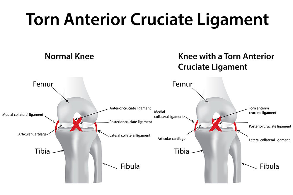 十字韌帶是位於膝關節內的兩條重要韌帶，分別為前十字韌帶和後十字韌帶。它們連接大腿骨(股骨)和脛骨，在奔跑、跳躍和轉換方向等動作中扮演著重要角色。
