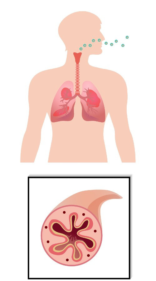 哮喘-受刺激發炎中的支氣管