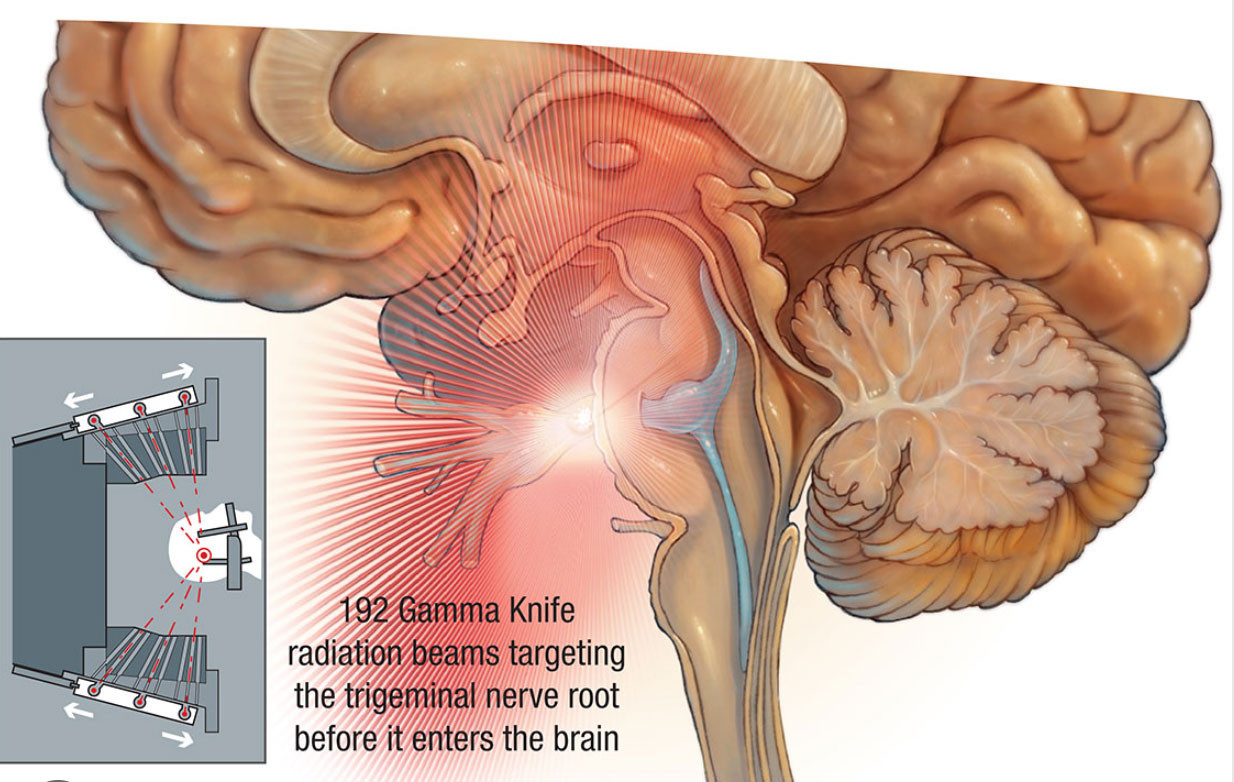伽马刀立体定位準确针对位於颅底的神经节进行放射治疗