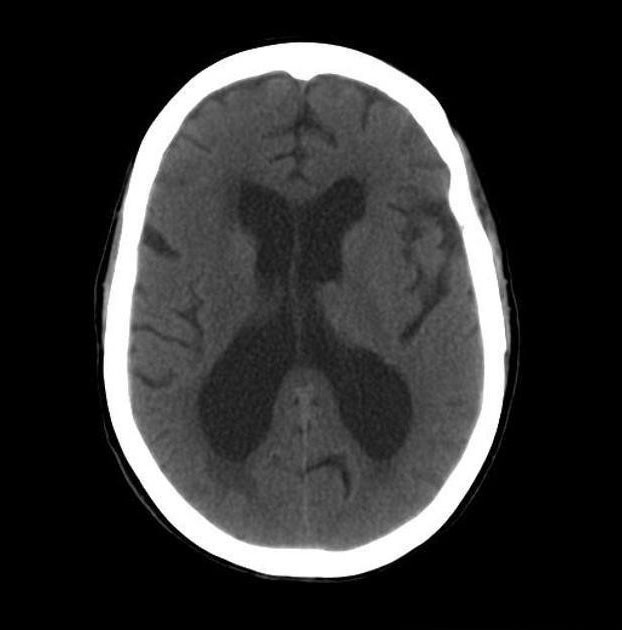 正常腦壓腦積水斷層圖1