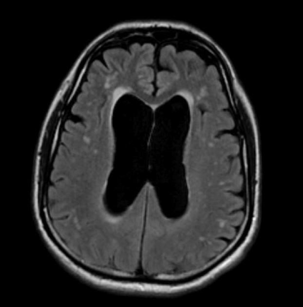 正常腦壓腦積水斷層圖2