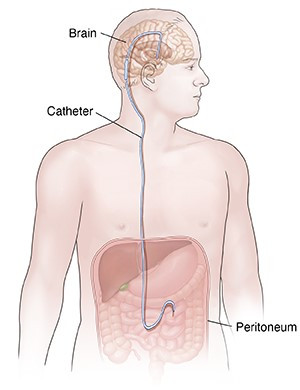 腦室腹腔引流手術