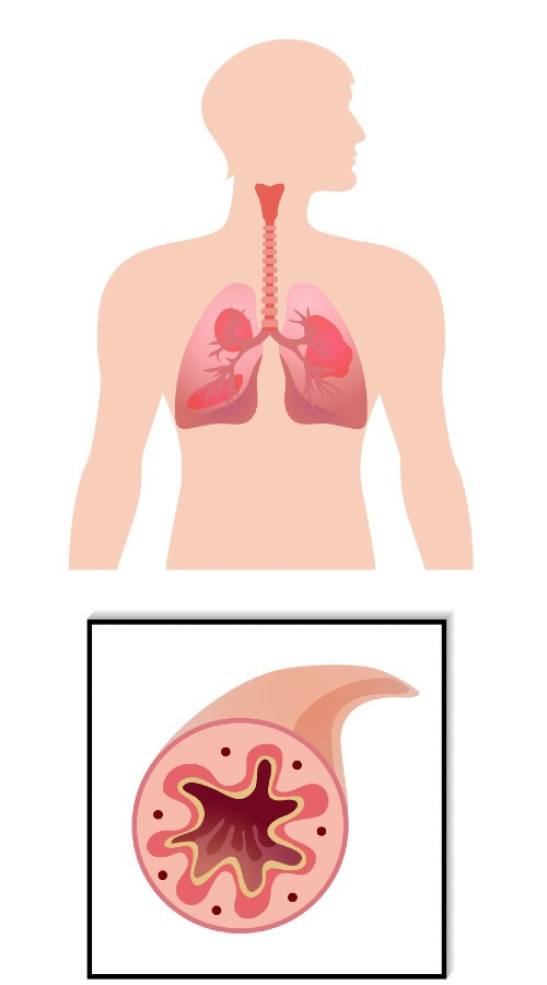 哮喘-哮喘患者發炎中的支氣管