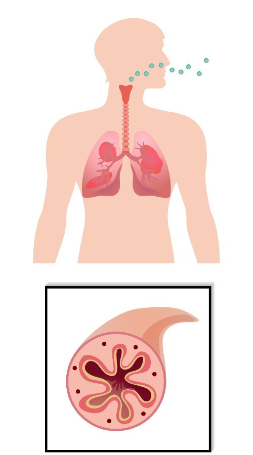 哮喘-受刺激發炎中的支氣管